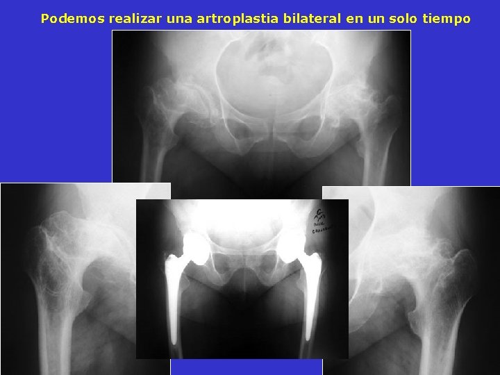 Podemos realizar una artroplastia bilateral en un solo tiempo Podemos realizar una artroplastia bilateral en un solo tiempo