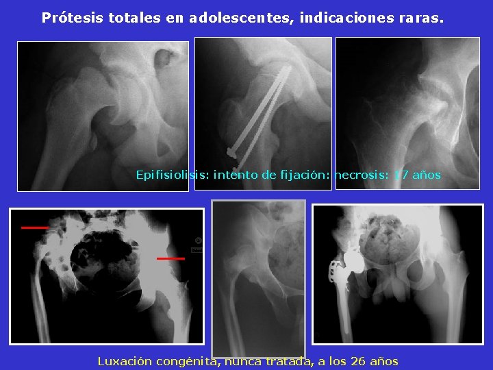 Prótesis totales en adolescentes, indicaciones raras. Epifisiolisis: intento de fijación: necrosis: 17 años Luxación Prótesis totales en adolescentes, indicaciones raras. Epifisiolisis: intento de fijación: necrosis: 17 años Luxación