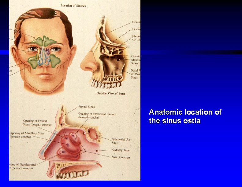 Anatomic location of the sinus ostia 