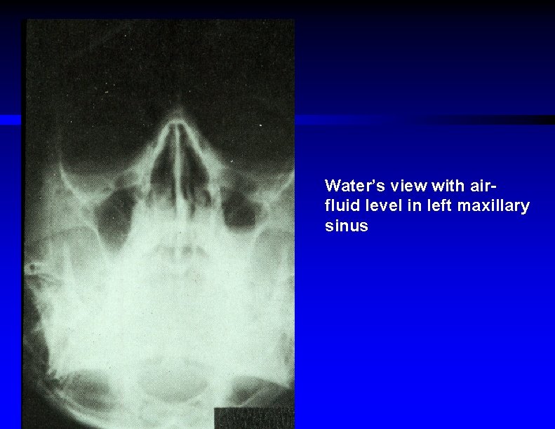 Water’s view with airfluid level in left maxillary sinus 