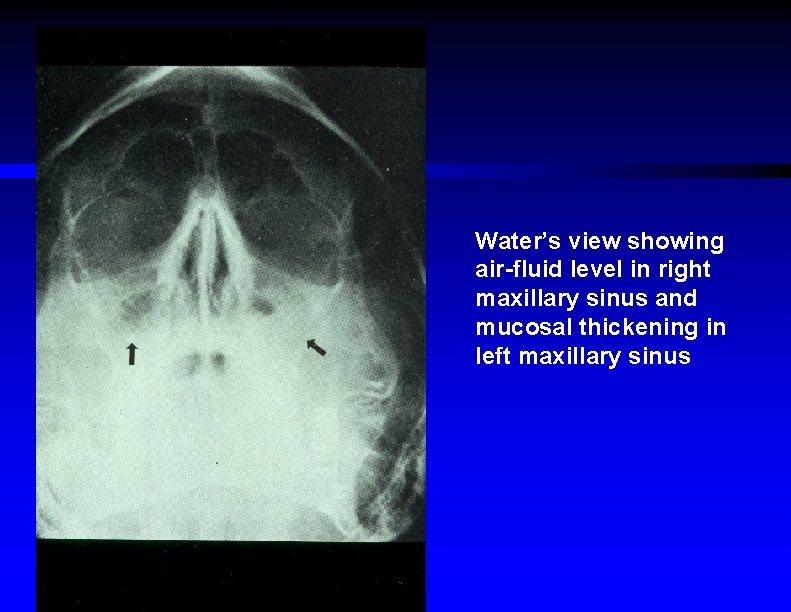 Water’s view showing air-fluid level in right maxillary sinus and mucosal thickening in left