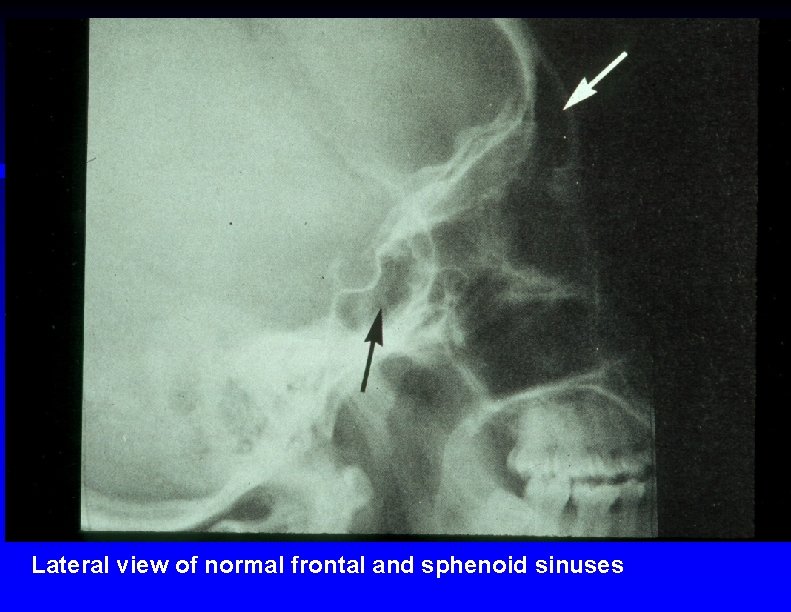 Lateral view of normal frontal and sphenoid sinuses 