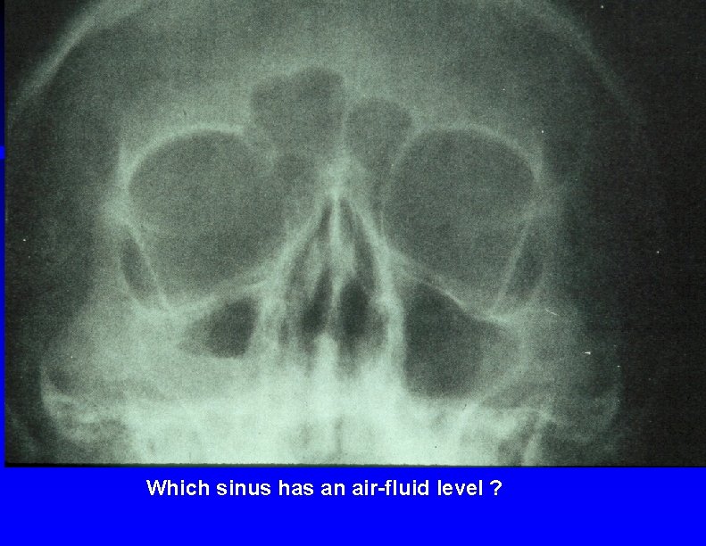 Which sinus has an air-fluid level ? 