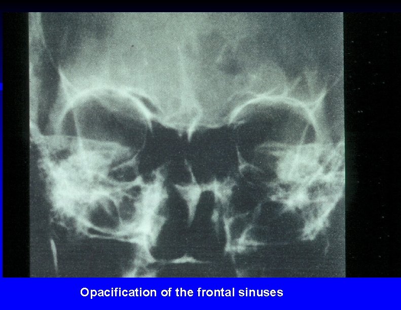 Opacification of the frontal sinuses 