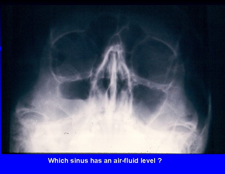 Which sinus has an air-fluid level ? 