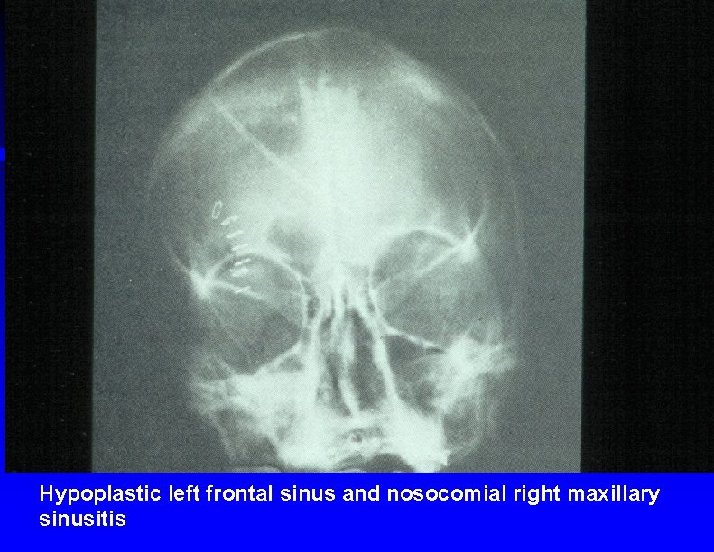 Hypoplastic left frontal sinus and nosocomial right maxillary sinusitis 