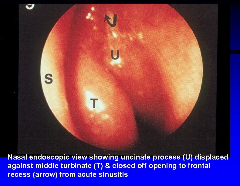 Nasal endoscopic view showing uncinate process (U) displaced against middle turbinate (T) & closed