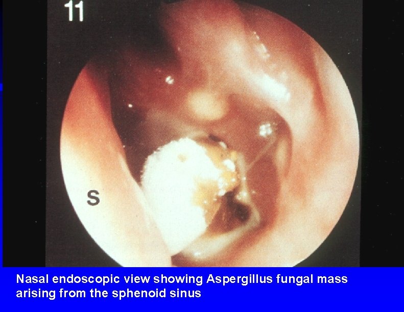 Nasal endoscopic view showing Aspergillus fungal mass arising from the sphenoid sinus 