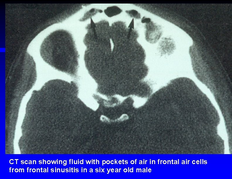 CT scan showing fluid with pockets of air in frontal air cells from frontal