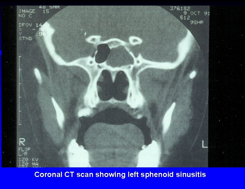 Coronal CT scan showing left sphenoid sinusitis 