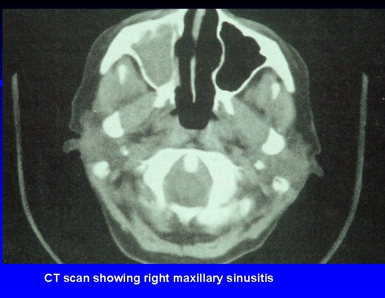 CT scan showing right maxillary sinusitis 