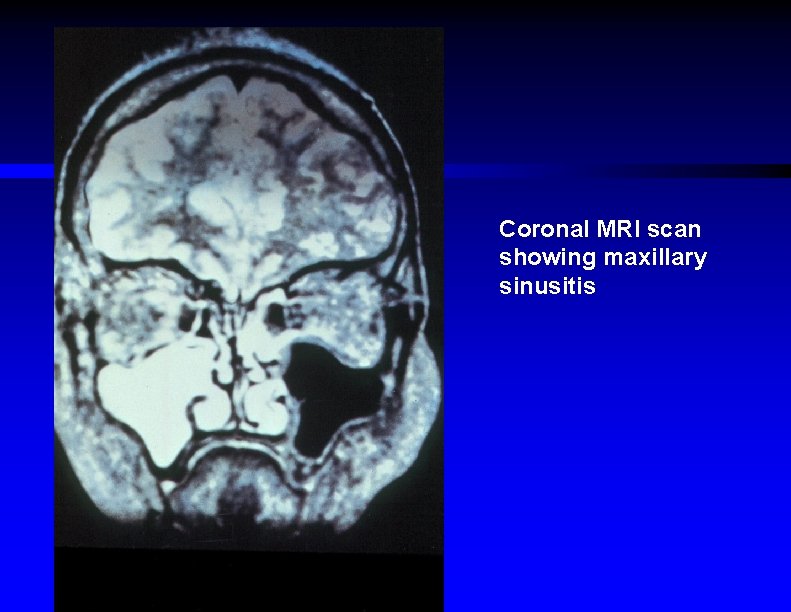 Coronal MRI scan showing maxillary sinusitis 