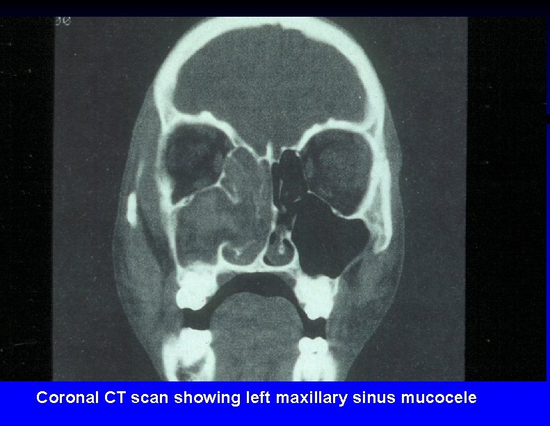 Coronal CT scan showing left maxillary sinus mucocele 