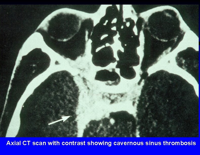 Axial CT scan with contrast showing cavernous sinus thrombosis 