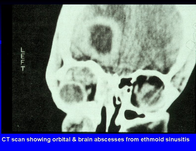 CT scan showing orbital & brain abscesses from ethmoid sinusitis 