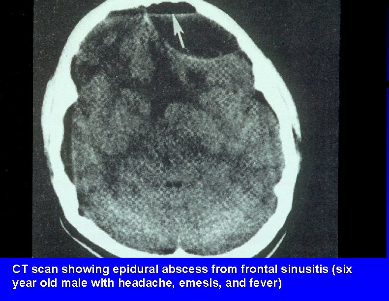 CT scan showing epidural abscess from frontal sinusitis (six year old male with headache,