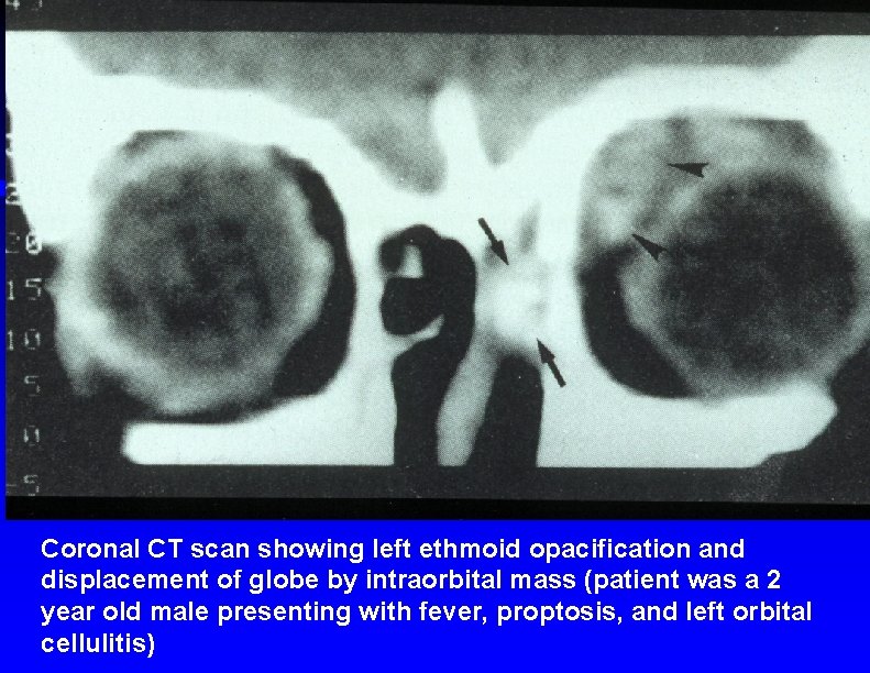 Coronal CT scan showing left ethmoid opacification and displacement of globe by intraorbital mass