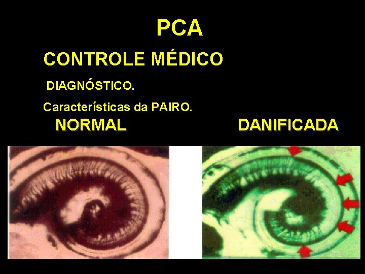 PCA CONTROLE MÉDICO DIAGNÓSTICO. Características da PAIRO. NORMAL DANIFICADA 