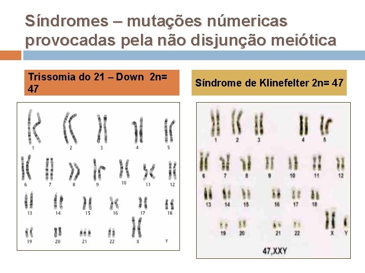 Síndromes – mutações númericas provocadas pela não disjunção meiótica Trissomia do 21 – Down