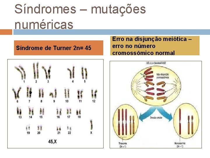 Síndromes – mutações numéricas Síndrome de Turner 2 n= 45 Erro na disjunção meiótica