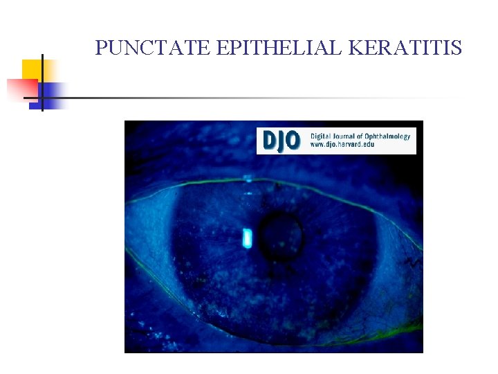 PUNCTATE EPITHELIAL KERATITIS PUNCTATE EPITHELIAL KERATITIS