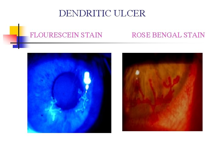 DENDRITIC ULCER FLOURESCEIN STAIN ROSE BENGAL STAIN DENDRITIC ULCER FLOURESCEIN STAIN ROSE BENGAL STAIN