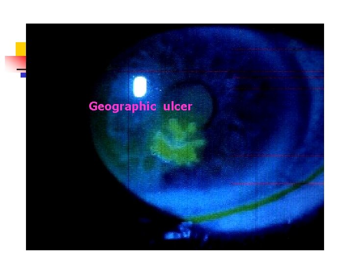 Geographic ulcer Geographic ulcer