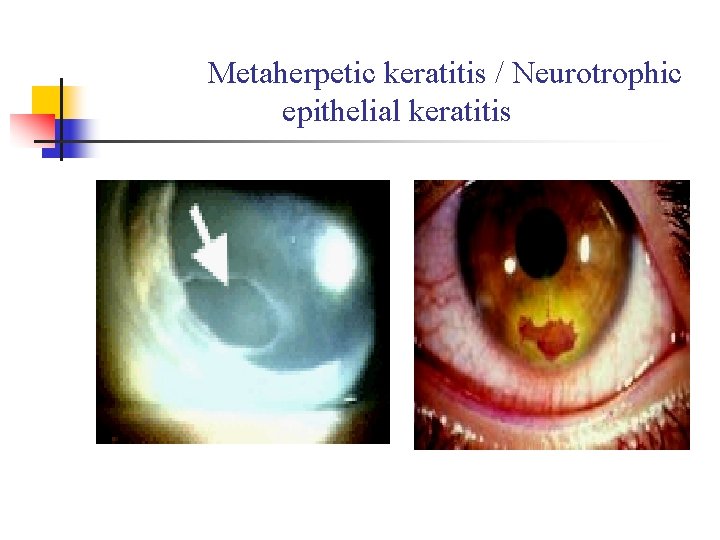 Metaherpetic keratitis / Neurotrophic epithelial keratitis Metaherpetic keratitis / Neurotrophic epithelial keratitis