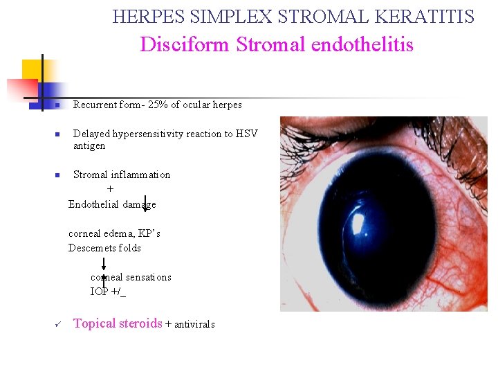 HERPES SIMPLEX STROMAL KERATITIS Disciform Stromal endothelitis n n n Recurrent form- 25% of HERPES SIMPLEX STROMAL KERATITIS Disciform Stromal endothelitis n n n Recurrent form- 25% of