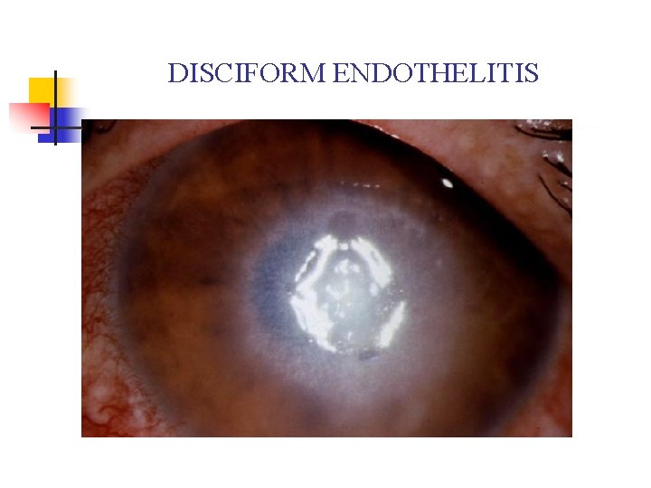 DISCIFORM ENDOTHELITIS DISCIFORM ENDOTHELITIS