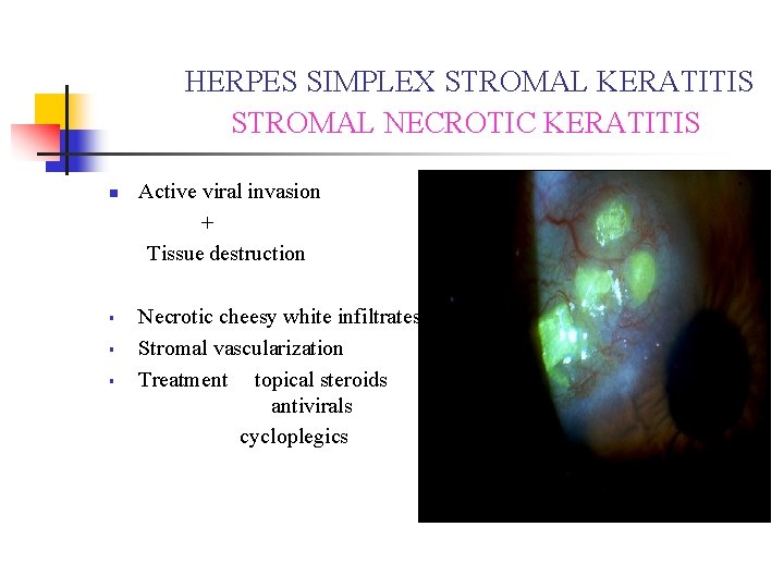HERPES SIMPLEX STROMAL KERATITIS STROMAL NECROTIC KERATITIS n § § § Active viral invasion HERPES SIMPLEX STROMAL KERATITIS STROMAL NECROTIC KERATITIS n § § § Active viral invasion