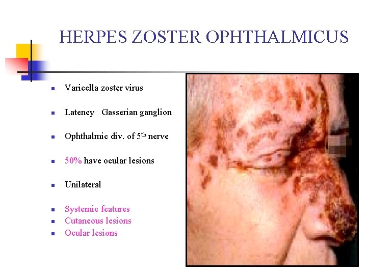HERPES ZOSTER OPHTHALMICUS n Varicella zoster virus n Latency Gasserian ganglion n Ophthalmic div. HERPES ZOSTER OPHTHALMICUS n Varicella zoster virus n Latency Gasserian ganglion n Ophthalmic div.