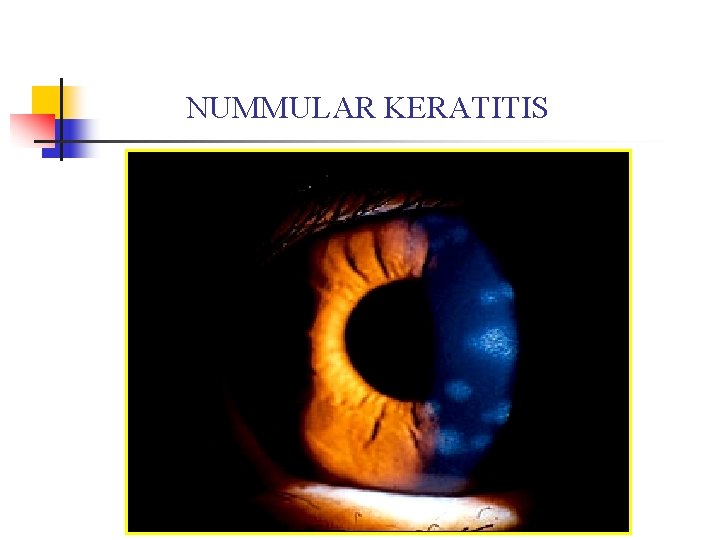 NUMMULAR KERATITIS NUMMULAR KERATITIS
