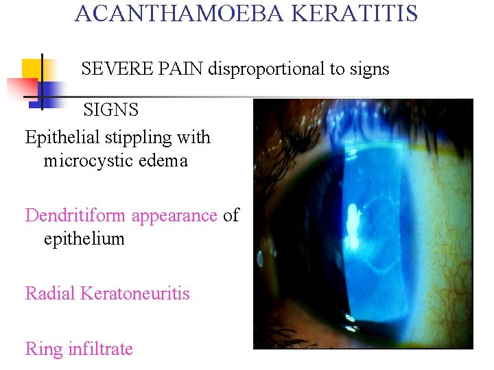 ACANTHAMOEBA KERATITIS SEVERE PAIN disproportional to signs SIGNS Epithelial stippling with microcystic edema Dendritiform ACANTHAMOEBA KERATITIS SEVERE PAIN disproportional to signs SIGNS Epithelial stippling with microcystic edema Dendritiform