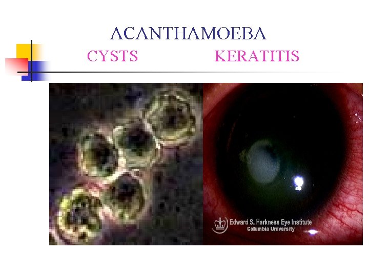 ACANTHAMOEBA CYSTS KERATITIS ACANTHAMOEBA CYSTS KERATITIS