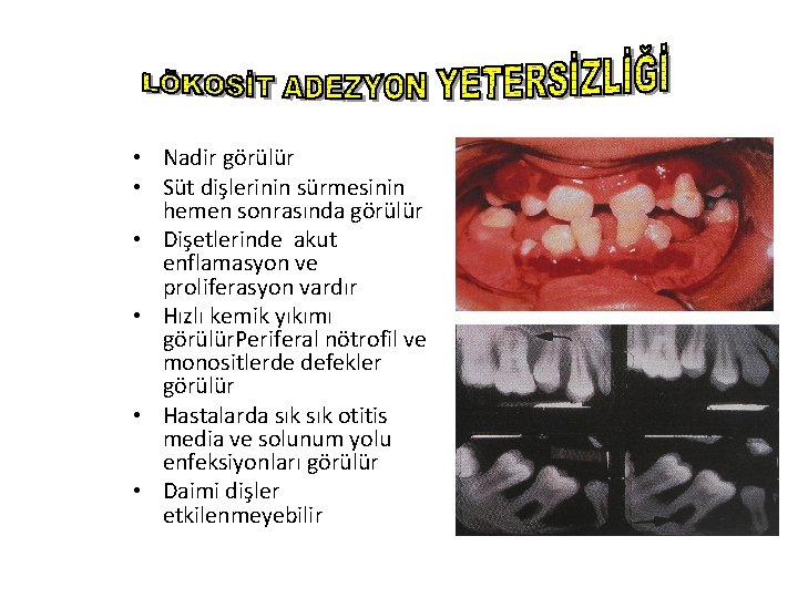  • Nadir görülür • Süt dişlerinin sürmesinin hemen sonrasında görülür • Dişetlerinde akut