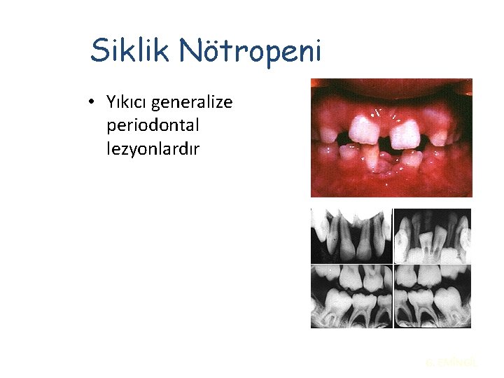 Siklik Nötropeni • Yıkıcı generalize periodontal lezyonlardır G. EMİNGİL 