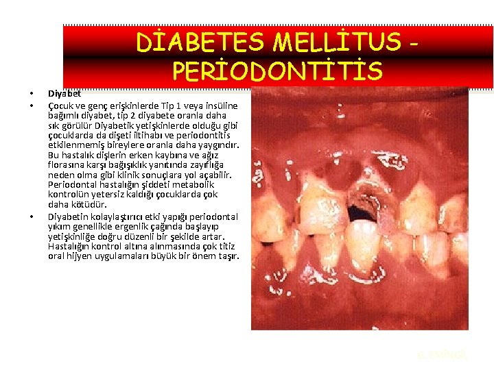  • • • DİABETES MELLİTUS PERİODONTİTİS Diyabet Çocuk ve genç erişkinlerde Tip 1