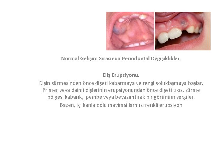 Normal Gelişim Sırasında Periodontal Değişiklikler. Diş Erupsiyonu. Dişin sürmesinden önce dişeti kabarmaya ve rengi