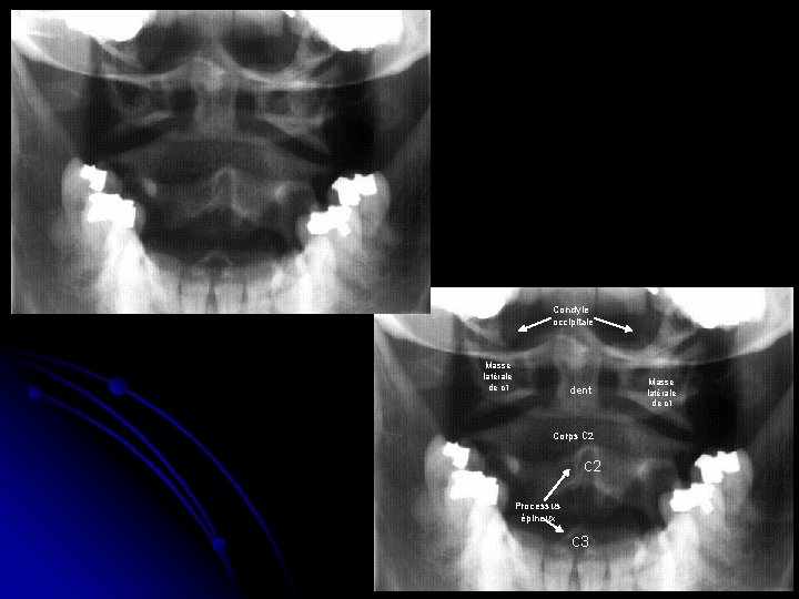 Condyle occipitale Masse latérale de c 1 dent Corps c 2 Processus épineux c