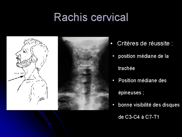 Rachis cervical • Critères de réussite : • position médiane de la trachée •