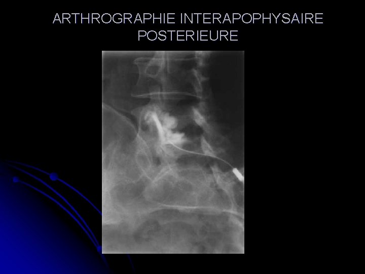ARTHROGRAPHIE INTERAPOPHYSAIRE POSTERIEURE 