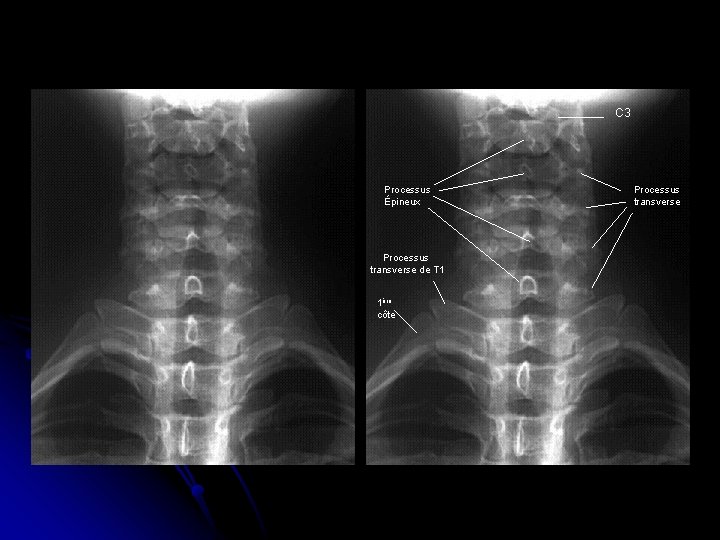 C 3 Processus Épineux Processus transverse de T 1 1ère côte Processus transverse 