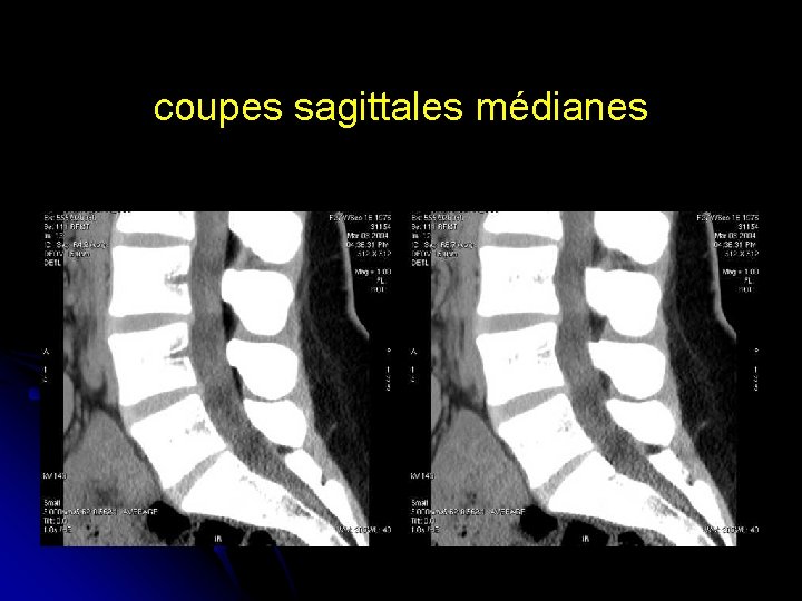 coupes sagittales médianes 