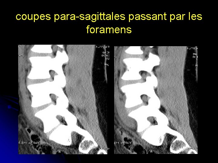 coupes para-sagittales passant par les foramens 