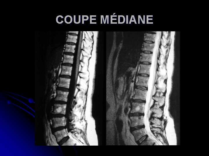 COUPE MÉDIANE 