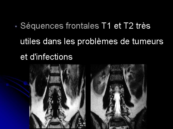  • Séquences frontales T 1 et T 2 très utiles dans les problèmes
