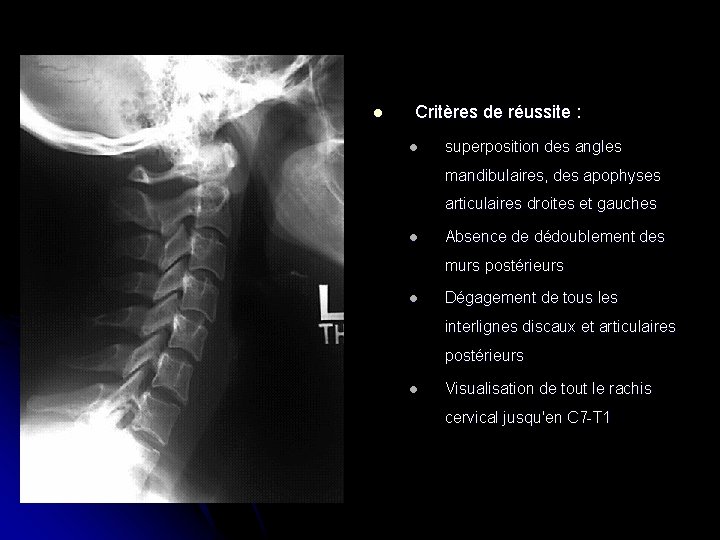 l Critères de réussite : l superposition des angles mandibulaires, des apophyses articulaires droites