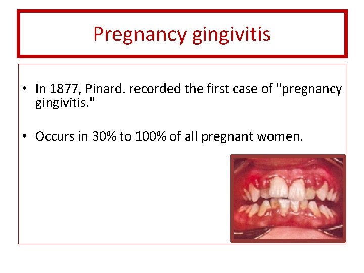 Pregnancy gingivitis • In 1877, Pinard. recorded the first case of "pregnancy gingivitis. "