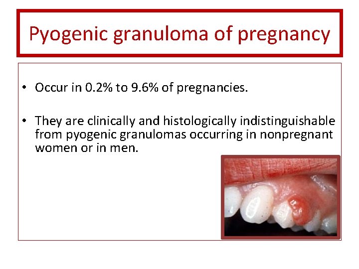 Pyogenic granuloma of pregnancy • Occur in 0. 2% to 9. 6% of pregnancies.
